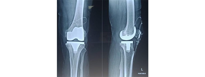 Knee Replacement Doctor in Thane